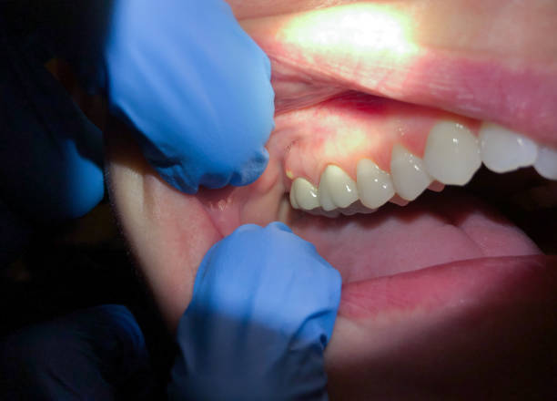 Best Emergency Dentist for Knocked-Out Tooth in Wintersville, OH